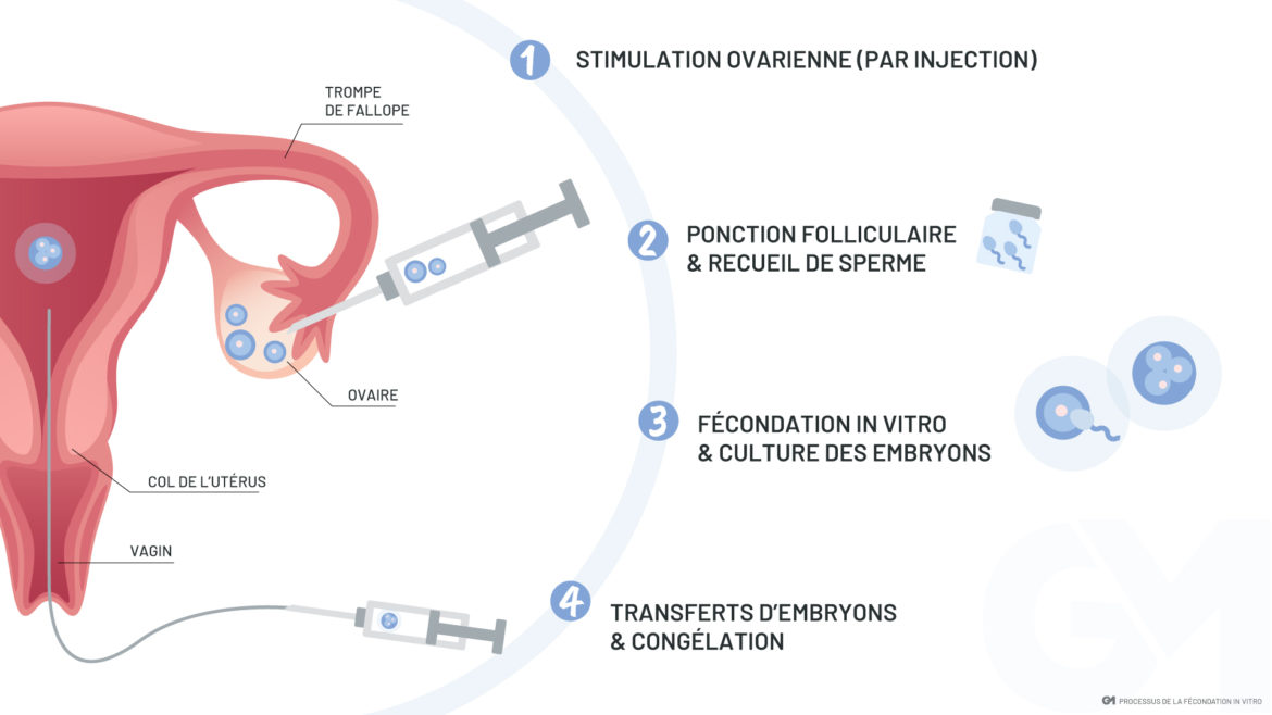 Fecondation In Vitro Marseille Gynécomarseille 3616